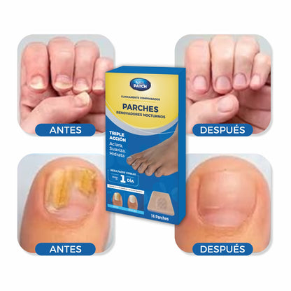 Parches AntiHongos y Regeneradores De Uñas - NailPatch®